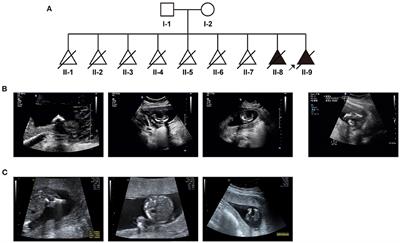 Case Report: Exome Sequencing Identified a Novel Compound Heterozygous Variation in PLOD2 Causing Bruck Syndrome Type 2